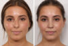 Rhinoplasty case #3944 slider thumbnail
