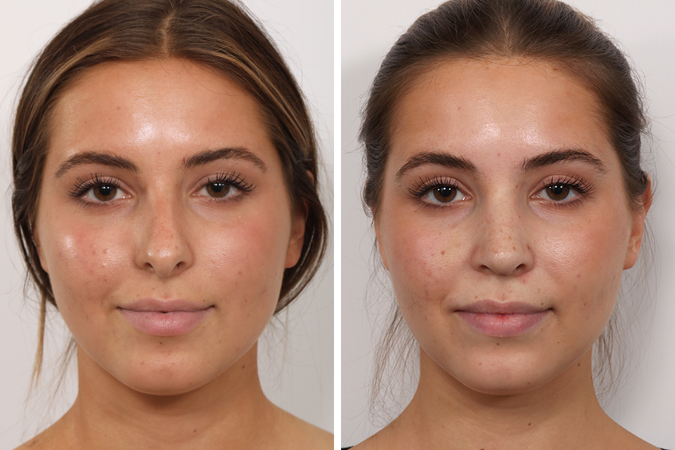 Rhinoplasty case #3944