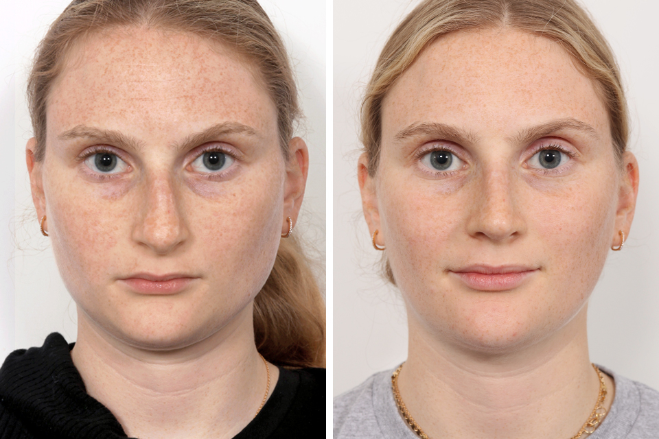 Rhinoplasty case #3975