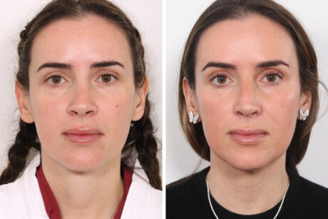 Rhinoplasty case #3977
