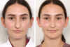 Rhinoplasty case #3983 slider thumbnail