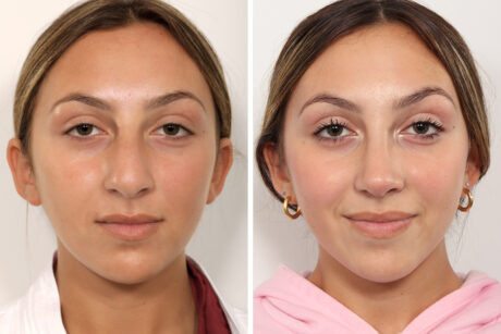 Rhinoplasty case #4082