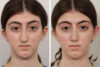 Rhinoplasty case #4107 slider thumbnail