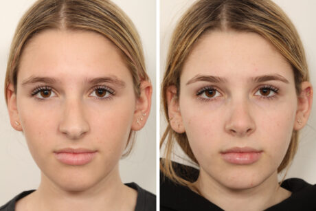 Rhinoplasty case #4135