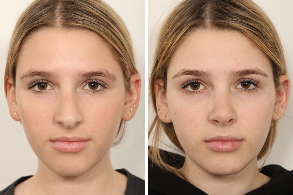 Rhinoplasty case #4135