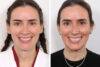 Rhinoplasty case #3977 slider thumbnail