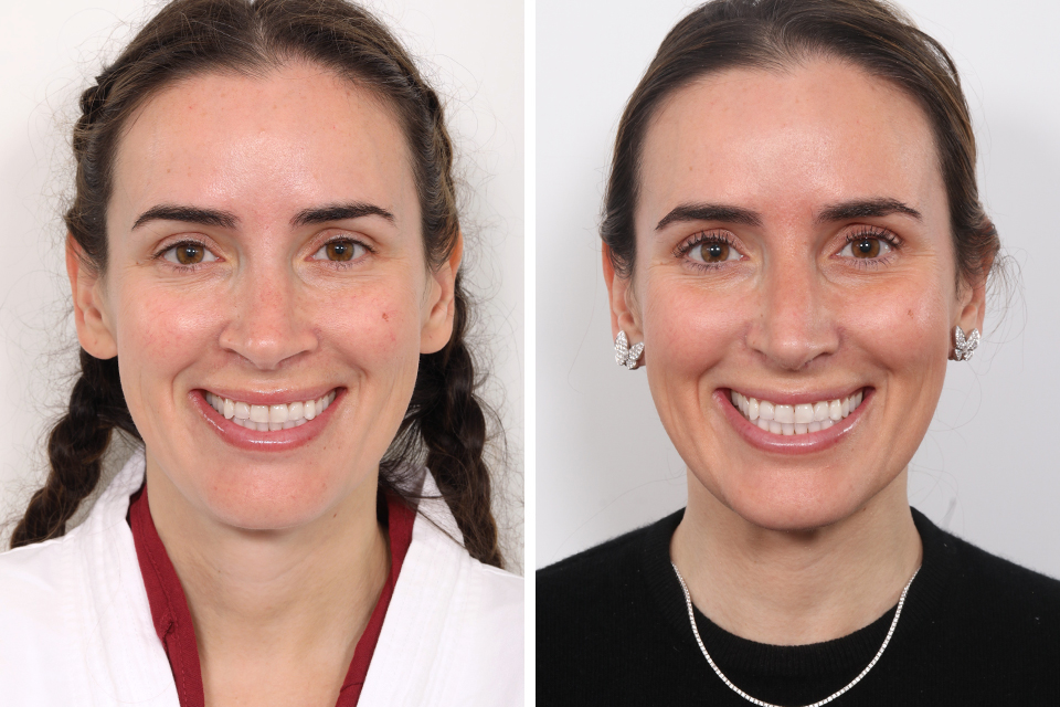 Rhinoplasty case #3977