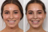 Rhinoplasty case #3944 slider thumbnail