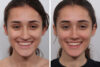 Rhinoplasty case #4075 slider thumbnail
