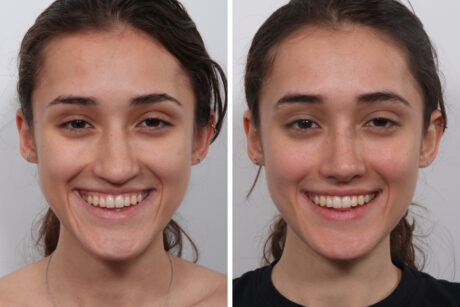 Rhinoplasty case #4075