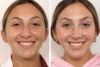 Rhinoplasty case #4082 slider thumbnail