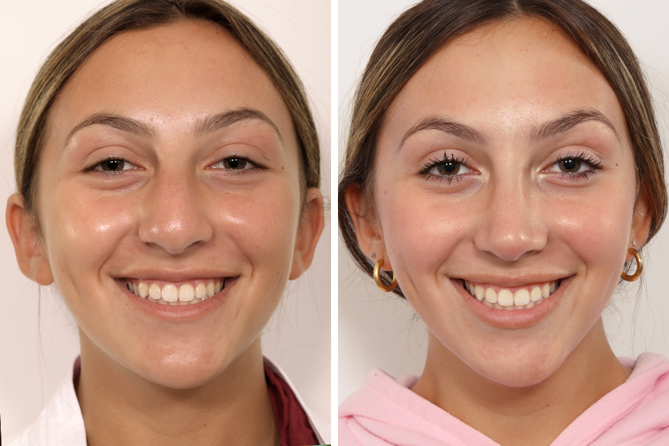 Rhinoplasty case #4082
