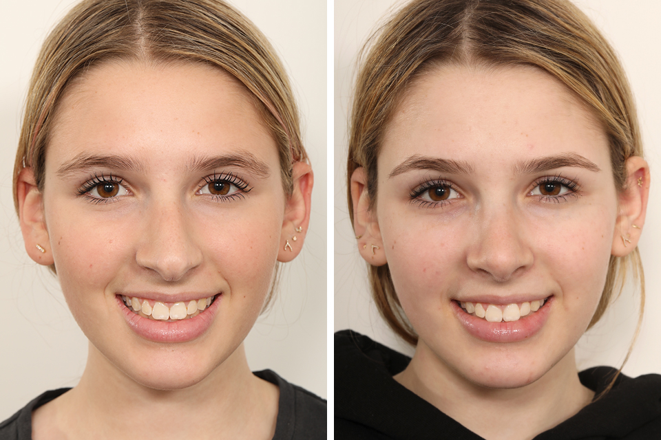Rhinoplasty case #4135