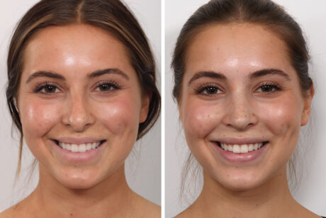 Rhinoplasty case #3944