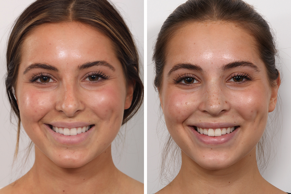 Rhinoplasty case #3944