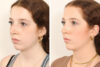 Rhinoplasty case #4050 slider thumbnail
