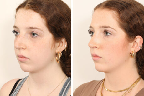 Rhinoplasty case #4050