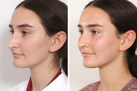 Rhinoplasty case #3983