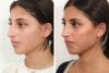 Rhinoplasty case #4008 slider thumbnail
