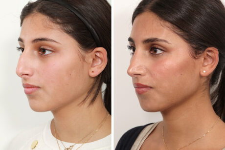 Rhinoplasty case #4008
