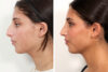 Rhinoplasty case #4008 slider thumbnail