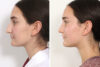 Rhinoplasty case #3983 slider thumbnail