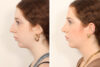 Rhinoplasty case #4050 slider thumbnail