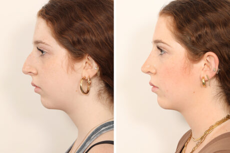 Rhinoplasty case #4050