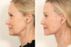 Rhinoplasty case #4064 slider thumbnail
