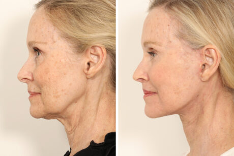 Rhinoplasty case #4064
