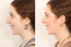 Rhinoplasty case #4050 slider thumbnail