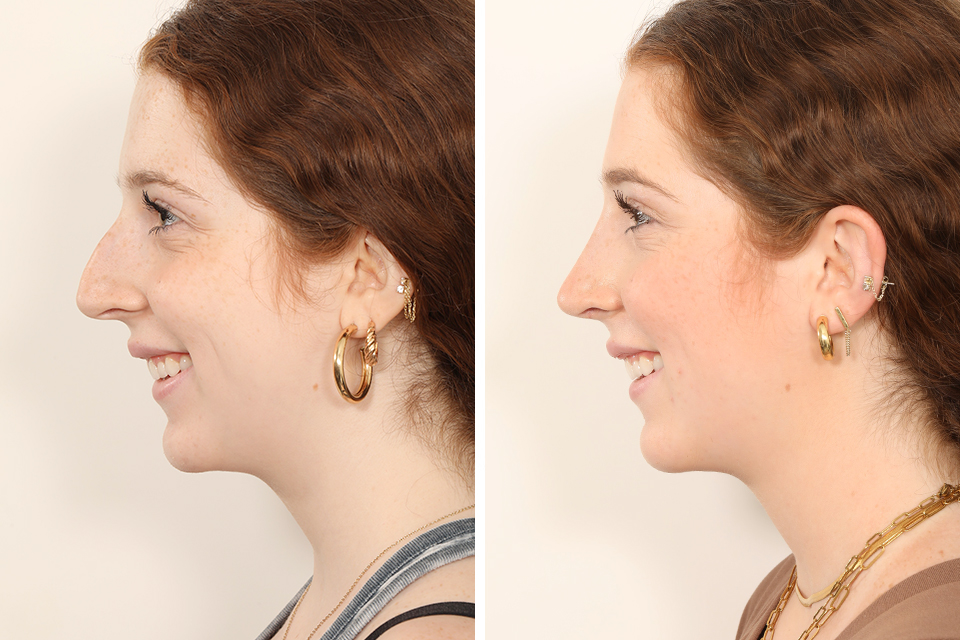 Rhinoplasty case #4050