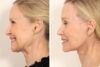 Rhinoplasty case #4064 slider thumbnail