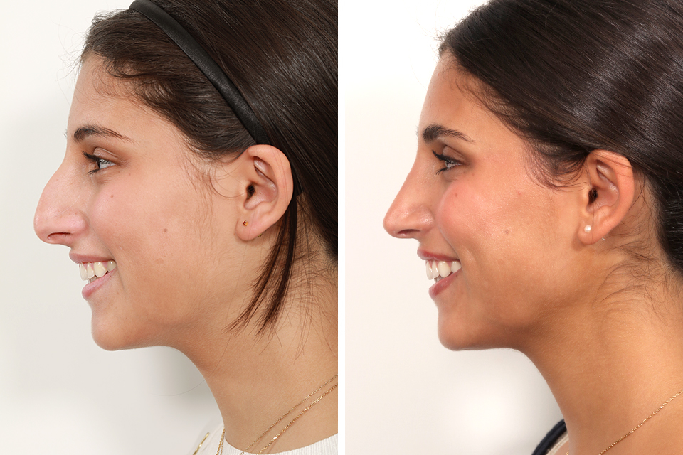Rhinoplasty case #4008