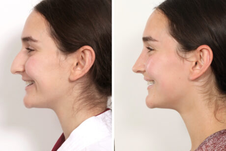 Rhinoplasty case #3983