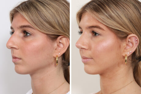 Rhinoplasty case #4070