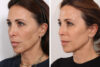 Rhinoplasty case #3961 slider thumbnail