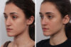 Rhinoplasty case #4075 slider thumbnail