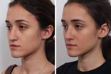 Rhinoplasty case #4075