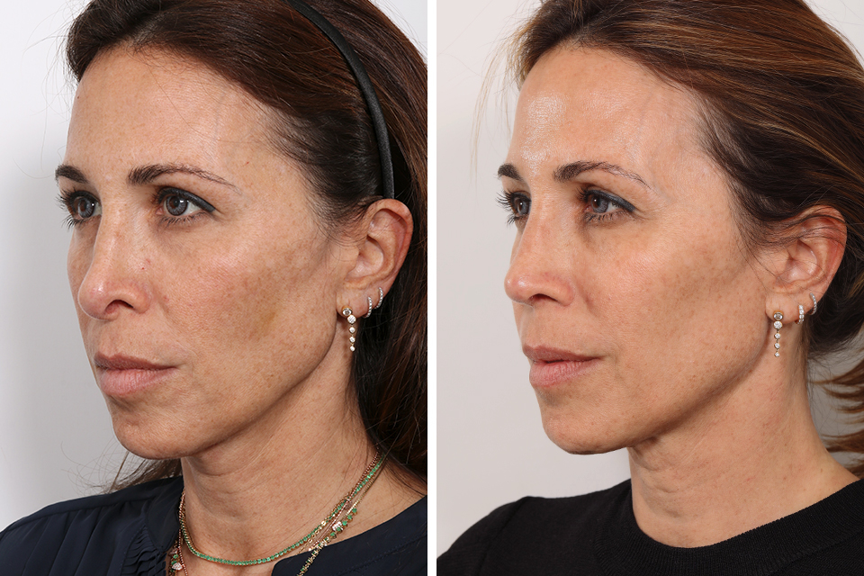 Rhinoplasty case #3961