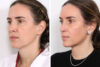 Rhinoplasty case #3977 slider thumbnail