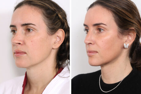 Rhinoplasty case #3977