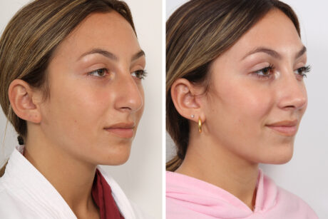 Rhinoplasty case #4082