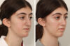 Rhinoplasty case #4107 slider thumbnail