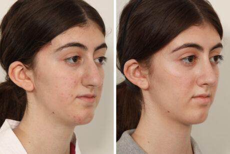 Rhinoplasty case #4107