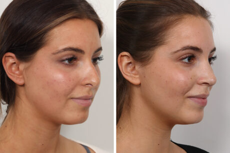 Rhinoplasty case #3944