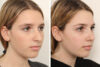 Rhinoplasty case #4135 slider thumbnail