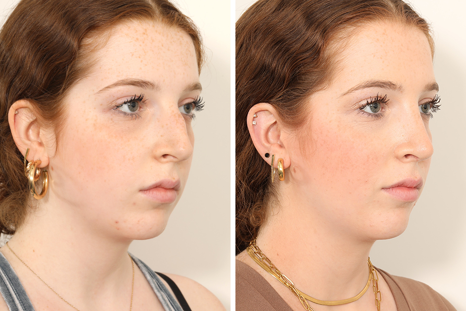 Rhinoplasty case #4050