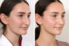 Rhinoplasty case #3983 slider thumbnail