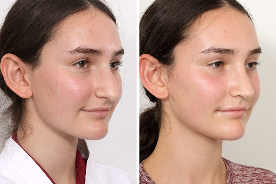 Rhinoplasty case #3983